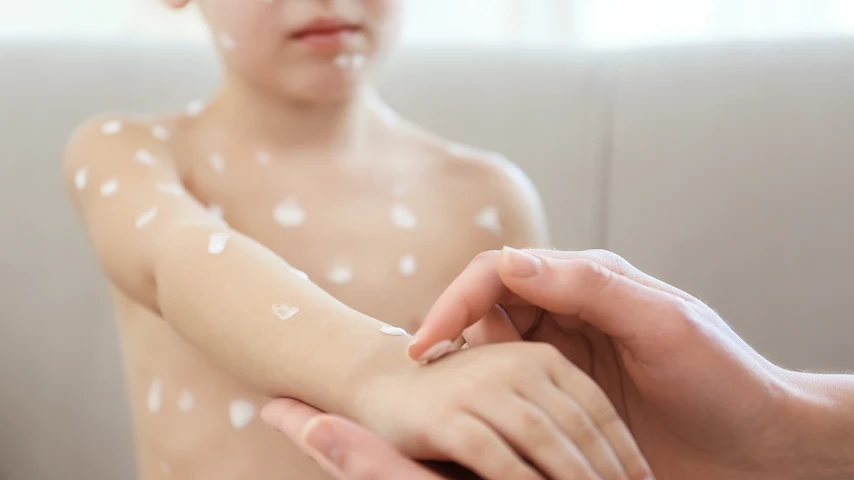 Female hands applying cream onto skin of child ill with chickenpox, on blurred background